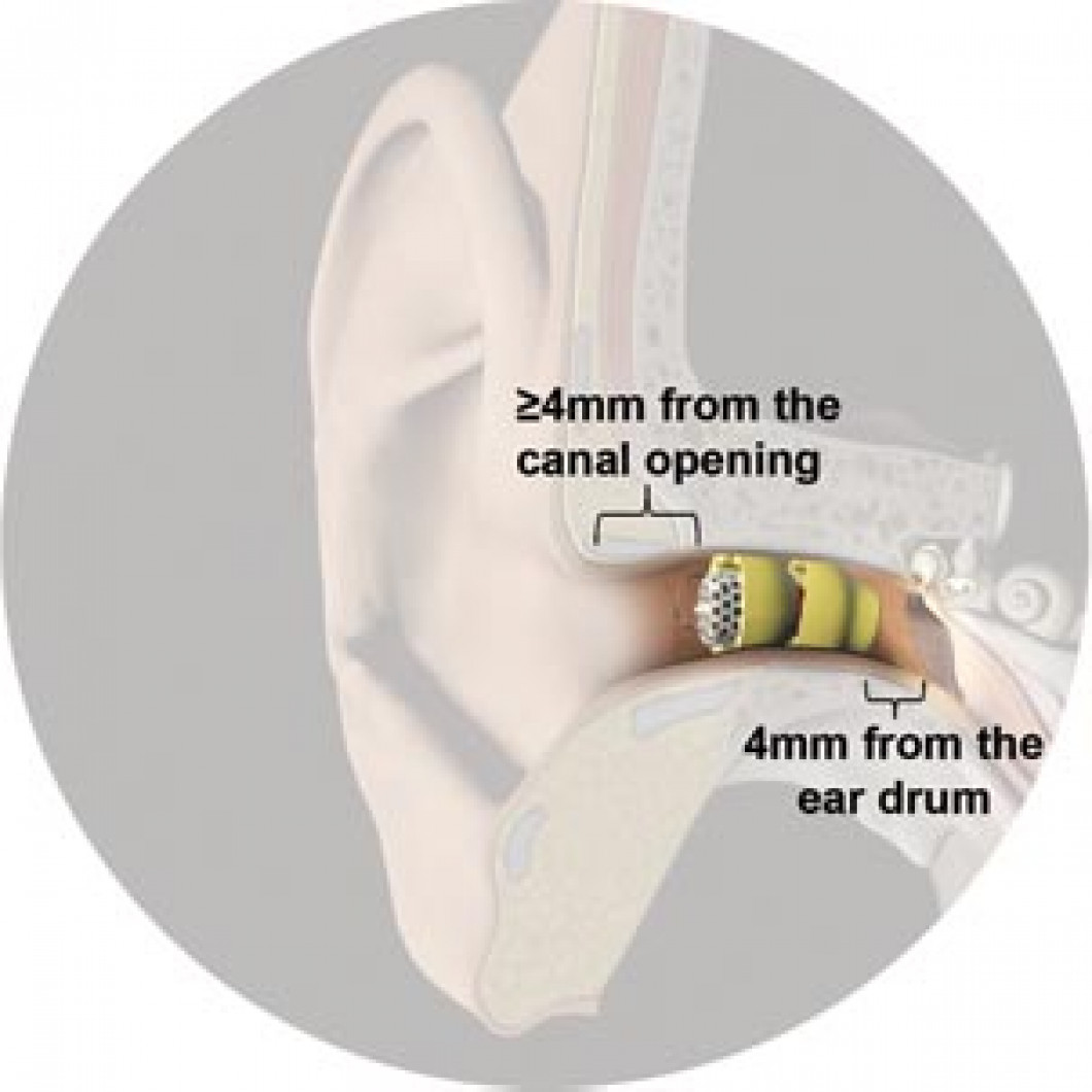 Extended Wear Hearing Aids Thompson Audiology